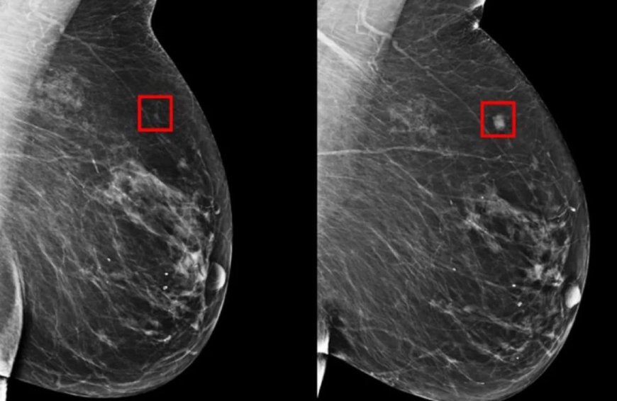 MIT's AI System Mirai: Revolutionizing Breast Cancer Risk Prediction